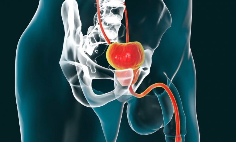 Clínica de Urologia Goiânia - Conheça as causas e sintomas da estenose de uretra