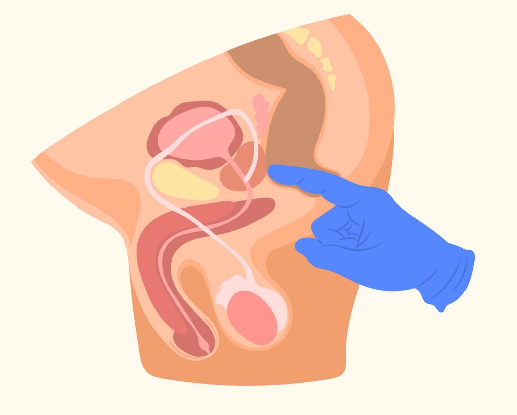 Urologista Goiânia - Rastreio do câncer de próstata quais exames são realizados