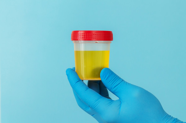 Sabia que o sangue na urina está presente em 90% dos casos de câncer de bexiga